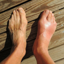 gout - foot