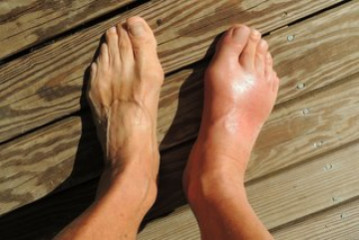 Gout – personal stories