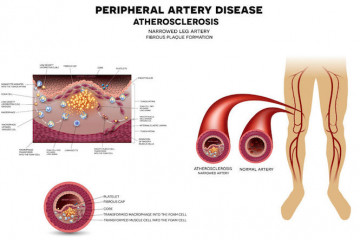 Peripheral vascular disease | Rerenga toto manauhea