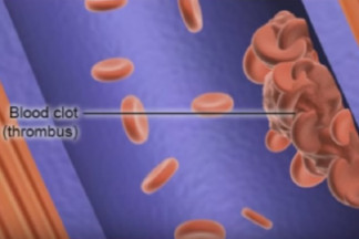 Deep vein thrombosis (DVT) videos