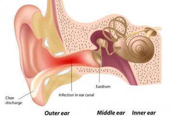 Outer ear infection or inflammation | Pokenga taringa