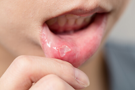 hpv cause mouth sores