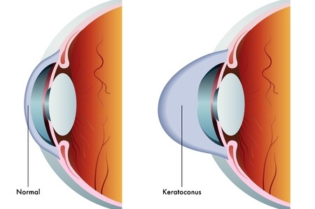 image of a normal eye and cornea compared to an eye with keratoconus