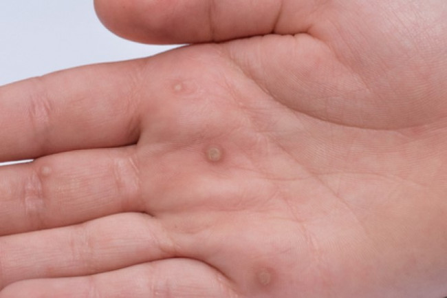 warts on hands spreading)