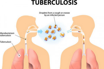 Tuberculosis 