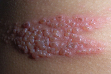 Pain after shingles