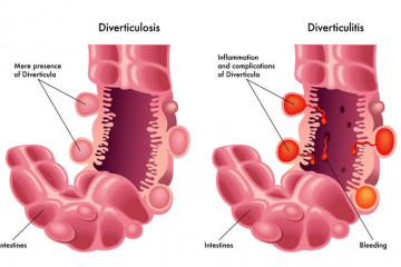 Diverticular disease and diverticulitis | Pūtautau i te whēkau